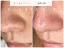 キュレイテッドスキン(CURATED SKIN)/ニキビ/シミ/毛穴/肌質改善/神戸