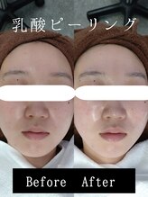 ビー ピボット店(Bee)/乳酸ピーリング