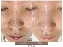 ポアレ 高崎店(POALE)/毛穴ケア症例【群馬/高崎】