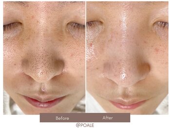 ポアレ 高崎店(POALE)/毛穴ケア症例【群馬/高崎】