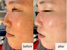 ミヌ 心斎橋(Minou)/ハーブピーリングbefore/after