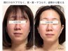 【人気No.1】なんかいつもと違う？っていわれる♪ほうれい線・たるみケア☆