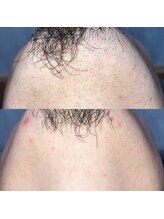 メンズ脱毛 リボーン(reborn)/まだまだ途中です