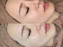 ブラン(BLANC)/ララピール　韓国肌管理