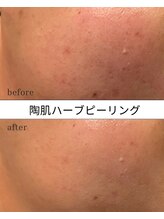 アンバー(amber)/ハーブピーリング毛穴の開きにも