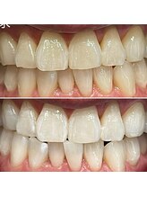 エピシアドットエヌ(epicia.N)/プレミアム1日でこの白さ☆