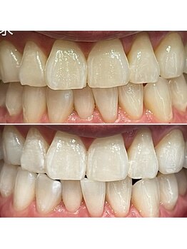 エピシアドットエヌ(epicia.N)/プレミアム1日でこの白さ☆