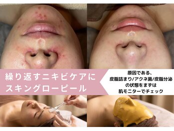 コキュウ お顔ラボ(KOKYU お顔LABO)/頑固な跡や赤みにも