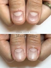 マリーロール 梅田店(Marie Laure)/深爪矯正/自爪育成/自爪風