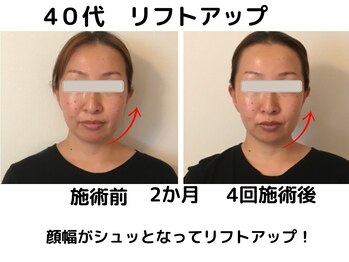 エンジェルエッグ/◆リフトUPだけでなく美肌にも！