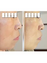 イーオ(io)/頬の大きなモヤっとしたシミ