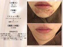 アクール(Accueil)/【ニキビ】
