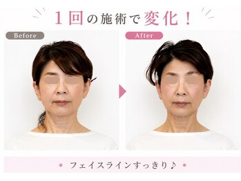 リフェイス(RE:FACE)の写真/印象チェンジ！中顔面・エラ張り・童顔を「なりたい自分」に。ホウレイ線・くすみ・輪郭にアプローチ！◎