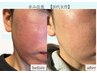 【繰り返すニキビ・肌荒れに】大人の肌荒れ集中ケア 60分