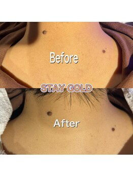 ステイゴールド 新百合ヶ丘(STAY GOLD)/うなじー!初脱毛☆☆