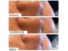 お試しコース【毛穴+小顔】毛穴洗浄&美顔電流60分13000→8500