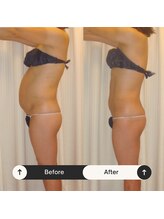 ユウキ(yuuki)/ぽっこりお腹もスッキリシェイプ