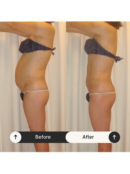 ユウキ(yuuki)/ぽっこりお腹もスッキリシェイプ