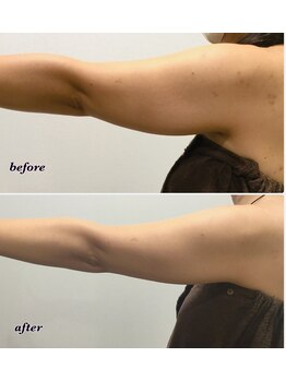 メンズアンドレディース エステティックサロン ティアラ(TiaLa)/二の腕もサイズダウンできます！