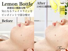 フラウ(Frau)の雰囲気（レモンボトル導入開始！EMSとLEDを同時施術で効果◎鎮静パック付）
