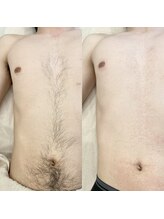 アクアカイロプラクティック/メンズボディ脱毛☆