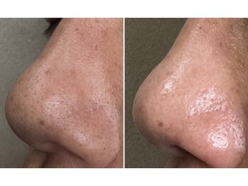 シェーン(Schon)/光フォトで鼻の毛穴改善！