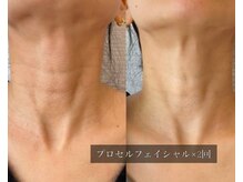 ル シーニュ/プロセルフェイシャル×2回