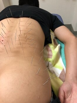 北京堂鍼灸首里 いじゅ治療院の写真/長めの中国鍼で腰・股関節回りのつらさをケア！深層筋までしっかり血流が巡る贅沢体験を♪