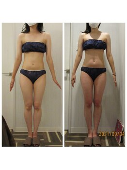 痩身脱毛専門店 グレイスボディ MEGAドンキホーテ三郷店(Gracebody)/◆痩身　症例写真