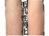 【剥離あり/ニキビケア】リベルハーブピーリング二の腕（2000円券付）