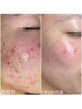 ラブリボン/短期プログラム