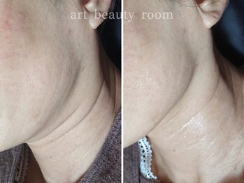 アート ビューティールーム(art beauty room)/☆OPL 光フェイシャル & 首 1回