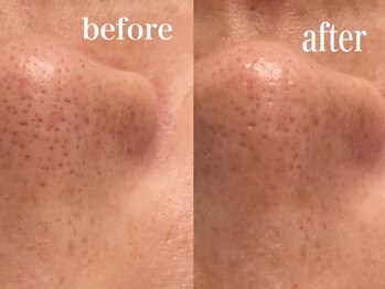 エンソワー(en'sower)/毛穴洗浄+美白シェービング