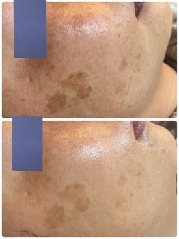 エヌプラスビューティー(N+beauty)/どんな肌でも内側からシミ改善！