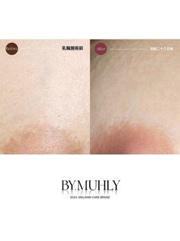 モア(more.)/おしり下黒ずみくすみ(1回)