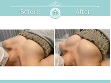 美人バスト 新潟店/ 【バストアップ★育乳】症例