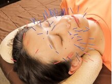 ナイン整骨院 三軒茶屋院/美容鍼