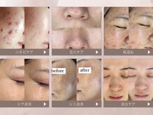 ホワイトアクア 福岡博多店(WHITE AQUA)の雰囲気（毛穴・ニキビケアに!芸能人御用達『REVIハーブピーリング』）