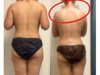 オーシャンブルーム 目黒(OceanBloom)/7回目痩身ハイパーナイフ