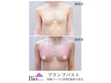バイオビューティー 神戸本店(Bio Beauty)/プランプバスト 体験コース症例