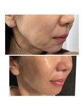 アリィ(Alii)/引き上げだけでなくふっくらも