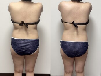 インナーメス(INNER MES)/全身痩身で変化続出!