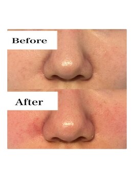 ライム 天神(LIME)/before&after 赤みケアに