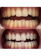 ハク 南船橋店(HAKU)/☆ホワイトニング☆事例写真４