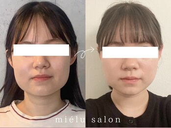 ミエル(mielu)/mielu式小顔矯正