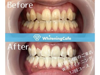 ホワイトニングカフェ 葛西店(WhiteningCafe)/◎歯のホワイトニング施術写真◎