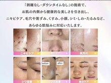 ホワイトアクア 池袋店(WHITE AQUA)/ハーブピーリング/毛穴洗浄/池袋