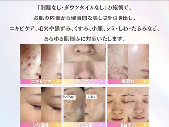 ホワイトアクア 池袋店(WHITE AQUA)/ハーブピーリング/毛穴洗浄/池袋