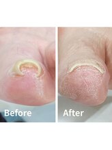 リゼラアンドコー 盛岡店/ドイツ式フットケア専門店　巻爪