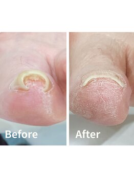 リゼラアンドコー 盛岡店/ドイツ式フットケア専門店　巻爪